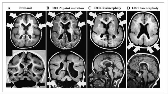 Brain magnetic resonance imaging of RELN-associated lissencephaly with cerebellar hypoplasia compared to classical lissencephaly.