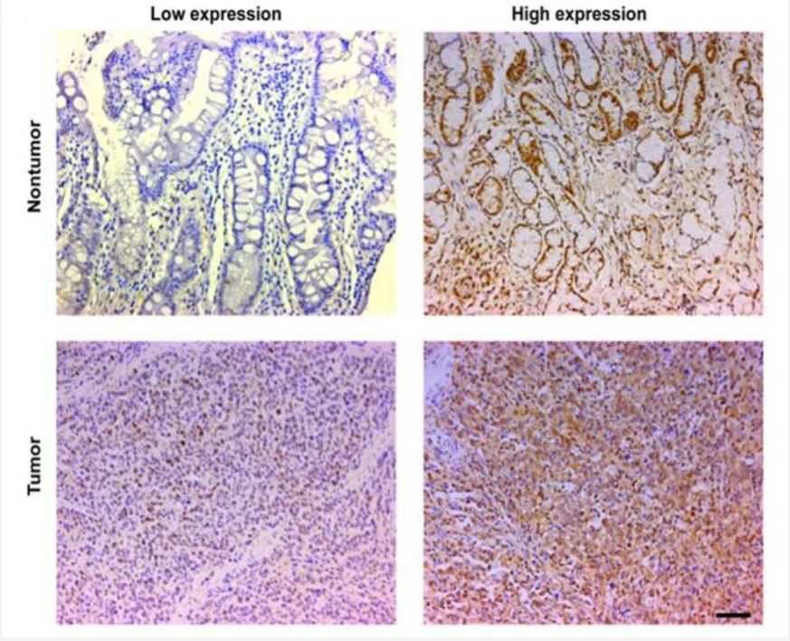 Representative IHC images of PSMD1 expression in nontumor and tumor tissues of GC patients.