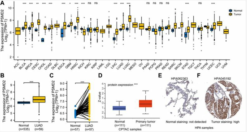 Expression pattern of PSMD2 in Pan-cancer perspective and lung adenocarcinoma.