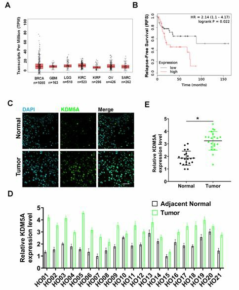 KDM5A in human osteosarcoma cancer tissues.
