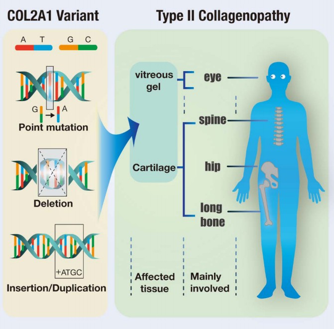 COL2A1 variants and associated diseases.