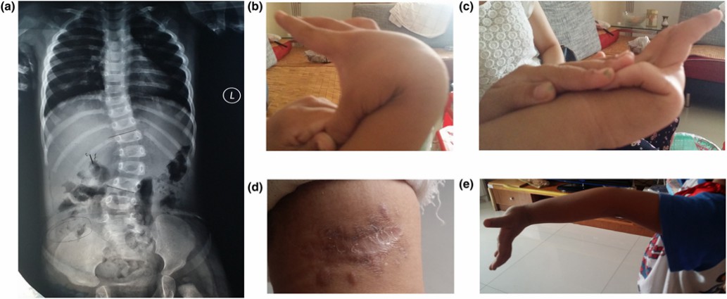 Clinical pictures of the Ehlers-Danlos patient.