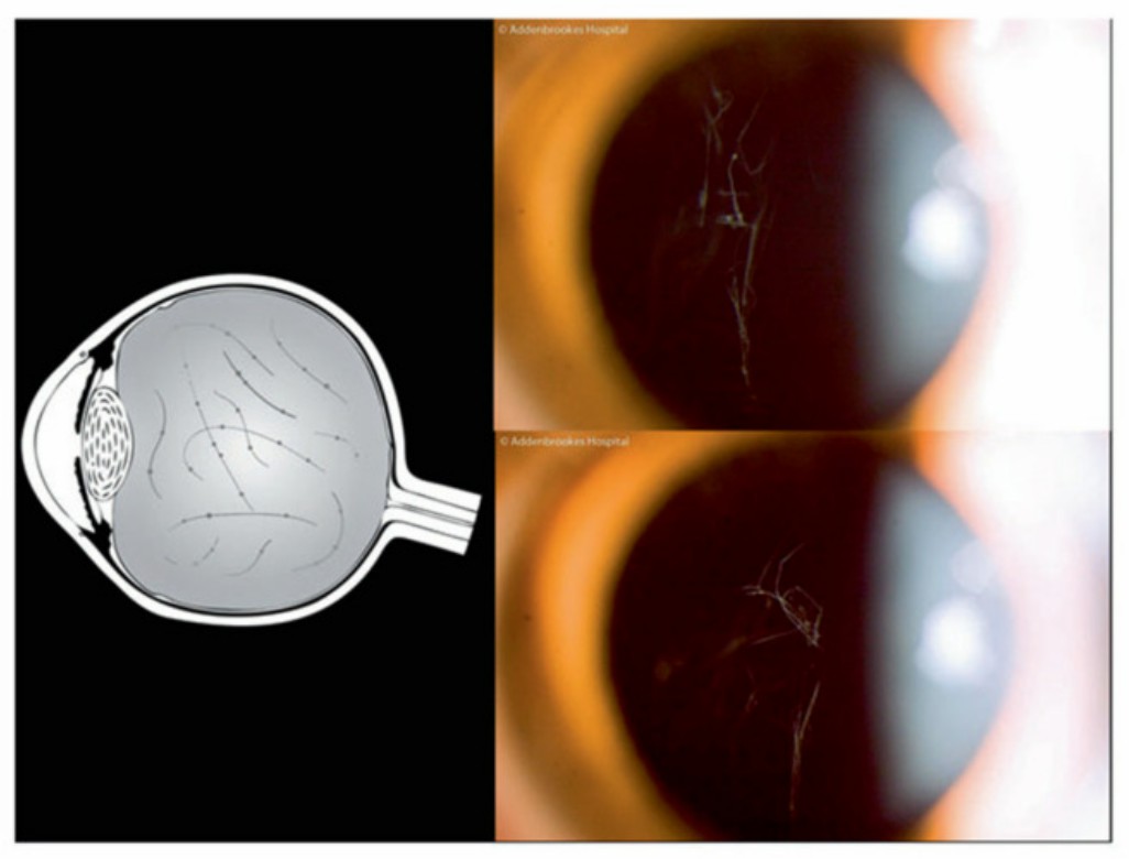 Beaded vitreous phenotypes associated with STL2.
