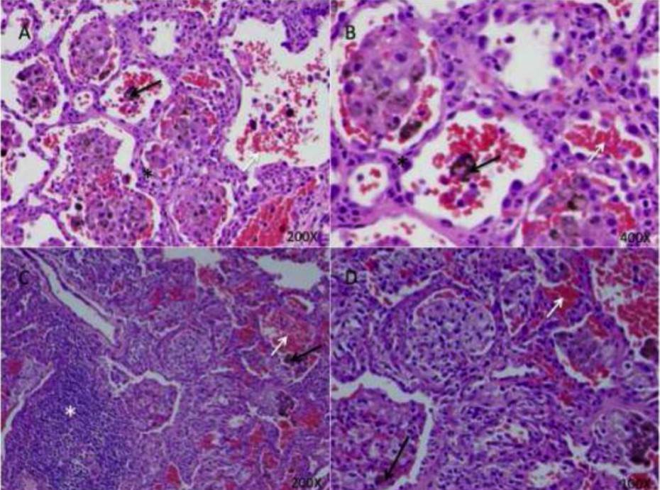 Lung histopathology from Copa syndrome patients.