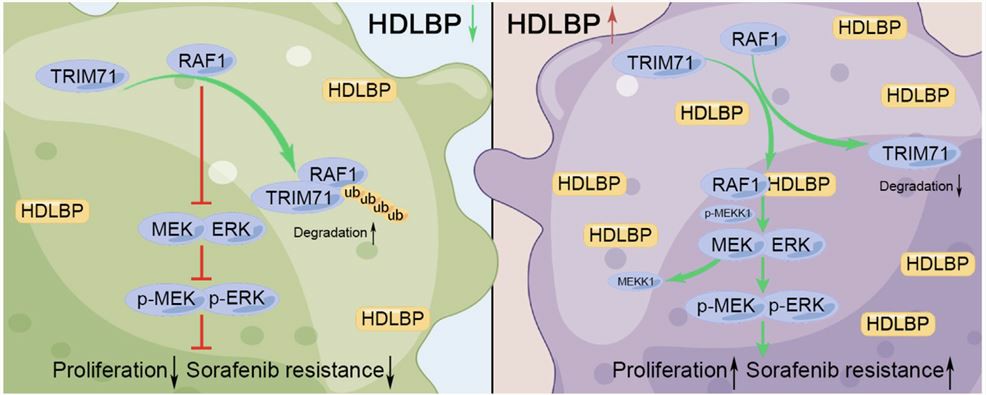 HDLBP expression is associated with the progression of HCC