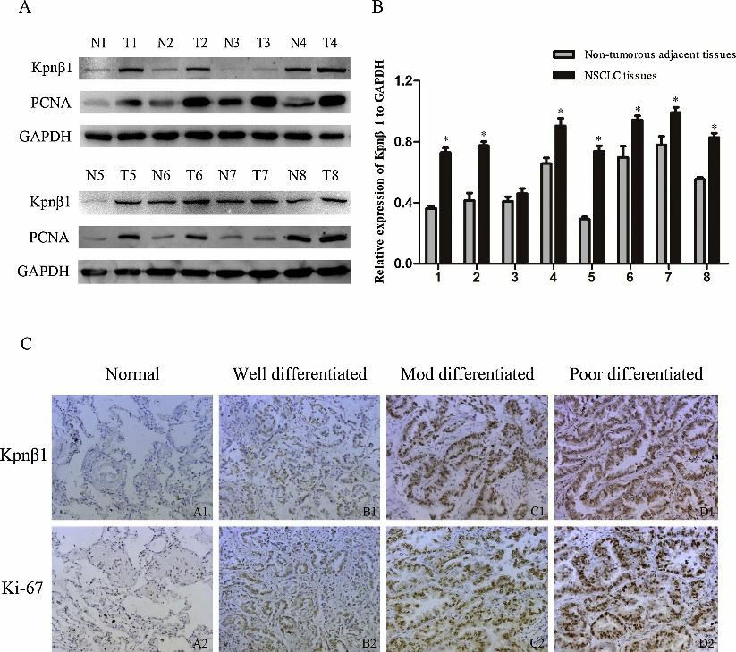 Kpnβ1 is highly expressed in NSCLC.