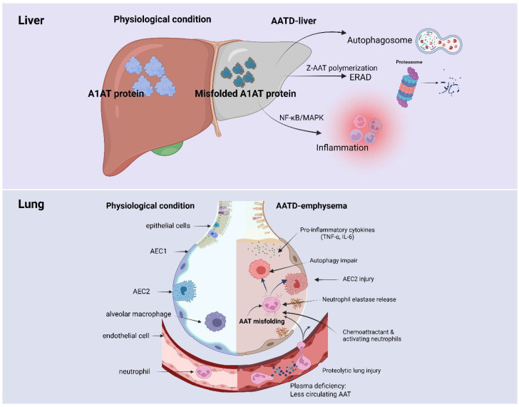 Figure 2: Pathophysiological mechanisms of liver and lung injury in alpha-1 antitrypsin deficiency (OA Literature)