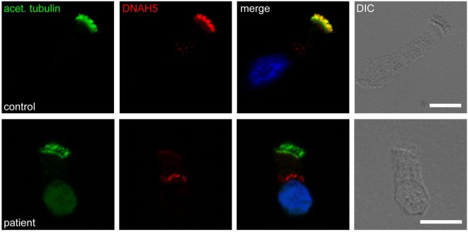 Figure 1: DNAH5 immunofluorescence localization in healthy and primary ciliary dyskinesia respiratory epithelial cells (OA Literature)