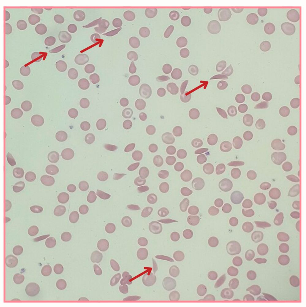 Figure 1. Peripheral blood smear obtained from a patient with sickle cell disease (SCD). （OA Literature）