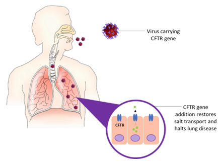 Viral vector-based gene therapy for cystic fibrosis.