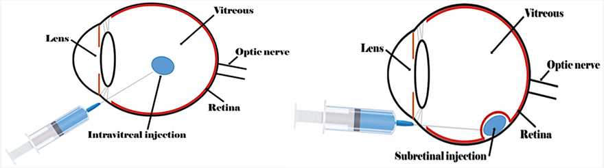 Intravitreal and subretinal injection of gene therapeutic viral vectors