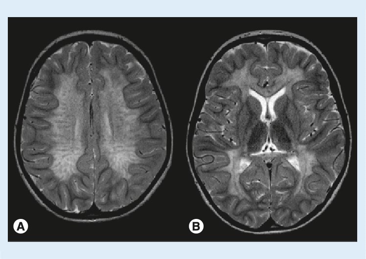 MRI in juvenile metachromatic leukodystrophy. (A) The central white matter shows signal hyperintensity and a streaky pattern, while the subcortical U fibers are spared. (B) Involvement of corpus callosum and posterior limb of internal capsule. 