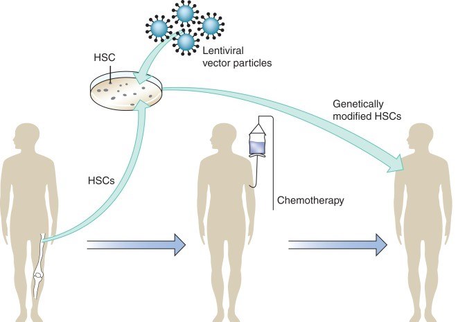 The procedures of Gene therapy by lentiviral vector particles.
