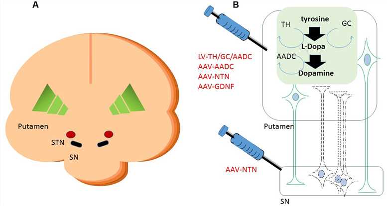 Figure 1. A Schematic Overview of Gene Therapeutic Approaches Targeting the Putamen. (OA Literature)