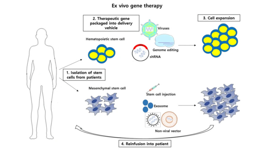 Figure 1: Ex vivo gene therapy using stem cells. (OA Literature)
