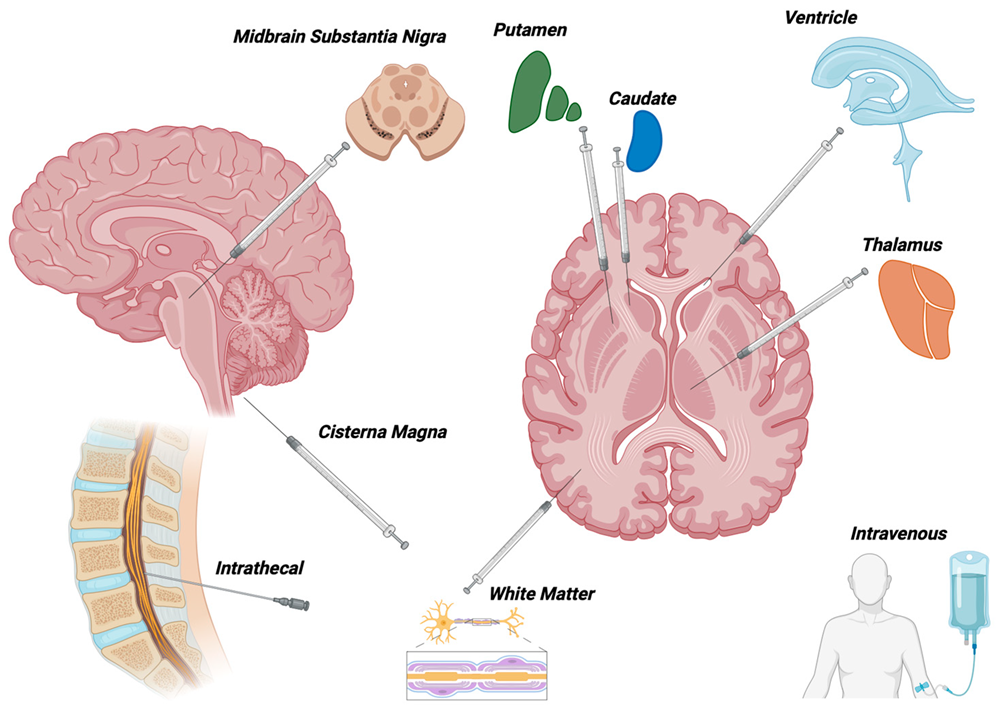 Modes of delivery for AAV-mediated gene therapy to the nervous system used in clinical trials