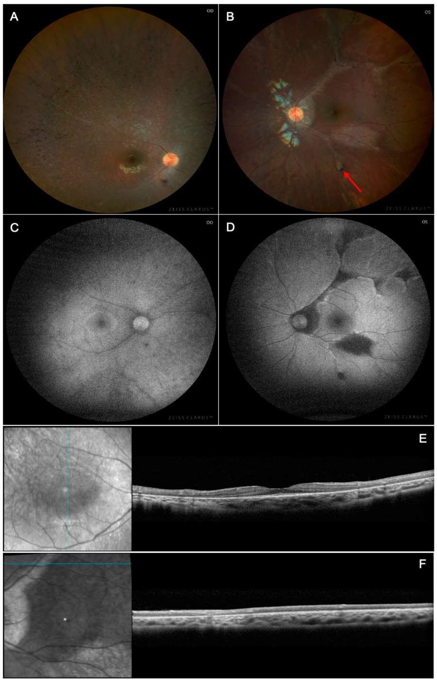 Figure 1. Multimodal imaging of chorioretinitis in X-linked chronic granulomatous disease. (OA Literature)