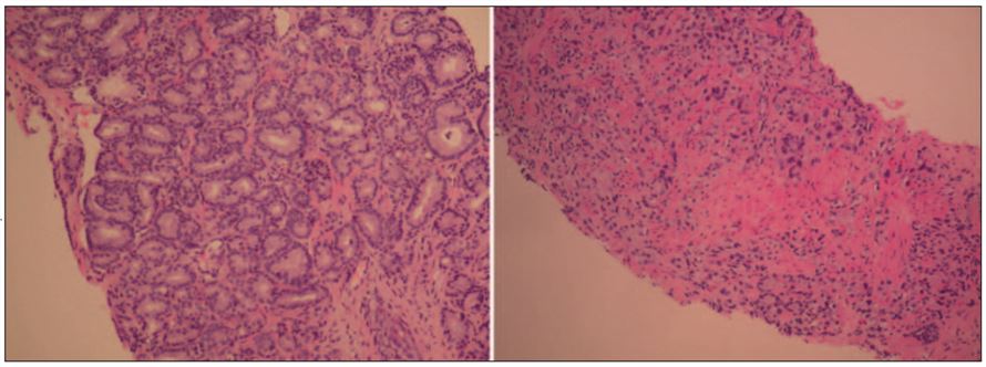 Micrographs of thin slices of prostate cancer tissue.