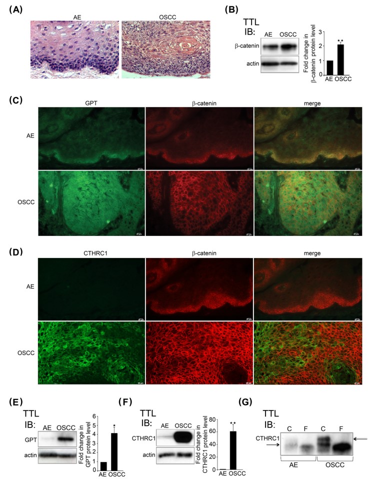 Fig. 2. Expression of β-catenin, GPT, and CTHRC1 in oral cancer. (OA Literature)