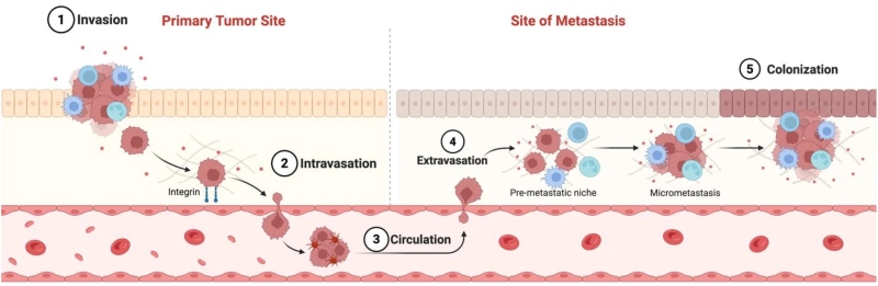 Fig 1. From Primary Tumor to Distant Metastasis: Key Steps. (OA Literature)