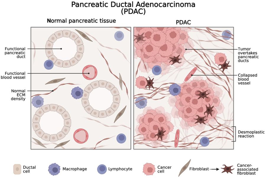 Fig.1 Schematic representation of the pancreatic ductal adenocarcinoma (PDAC) tumor microenvironment (TME). (OA Literature)