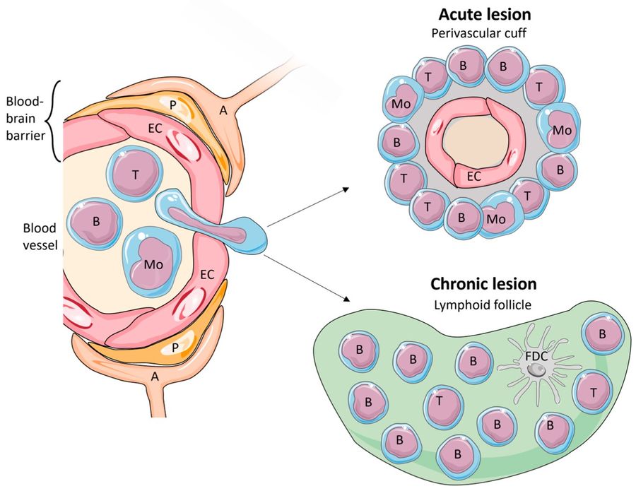 Fig.1 Transmigration of immune cells across the blood–brain barrier in multiple sclerosis. (OA Literature)