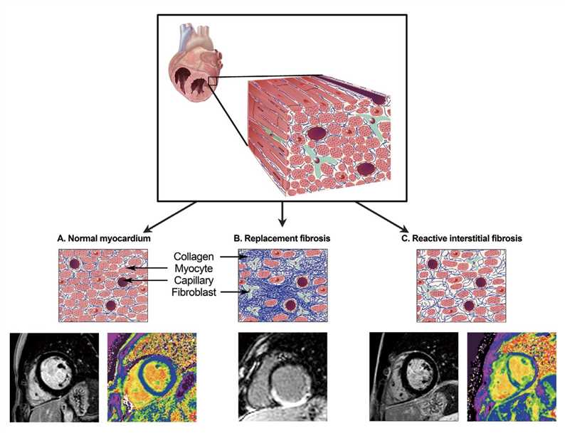Histopathology of Myocardial Fibrosis.