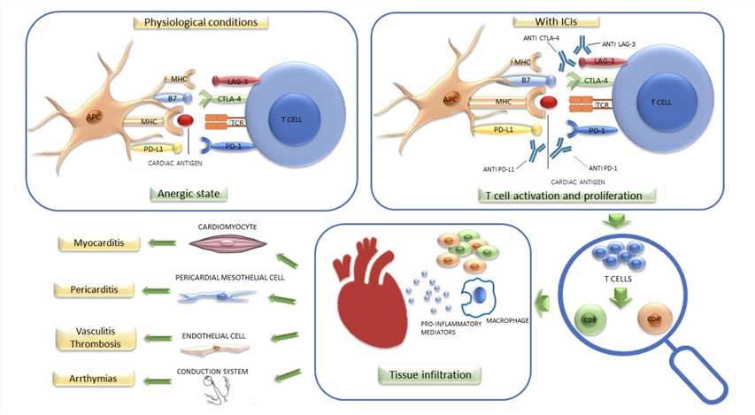 Potential Pathogenetic Mechanism of Cardiotoxicity Induced by Immune Checkpoint Inhibitors (ICIs).