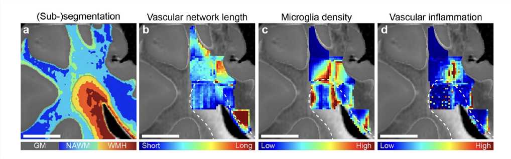 Vascular Network Length, Microglia Density and Vascular Inflammation in WMH and NAWM.