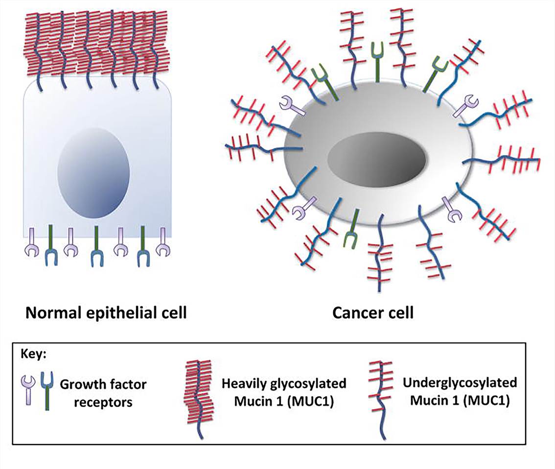 MUC1 overexpression and loss of polarity in cancer cells. (Nath, 2014)