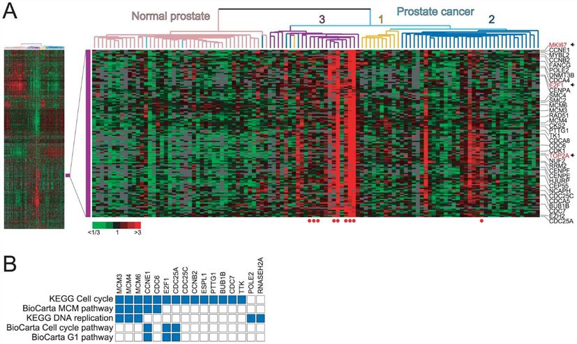 Fig.1 Identification and characterization of a proliferation signature cluster in prostate cancer. (OA Literature)