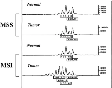 Fig.1 Illustrative electropherograms comparing microsatellite markers in normal versus tumor DNA. (OA Literature)