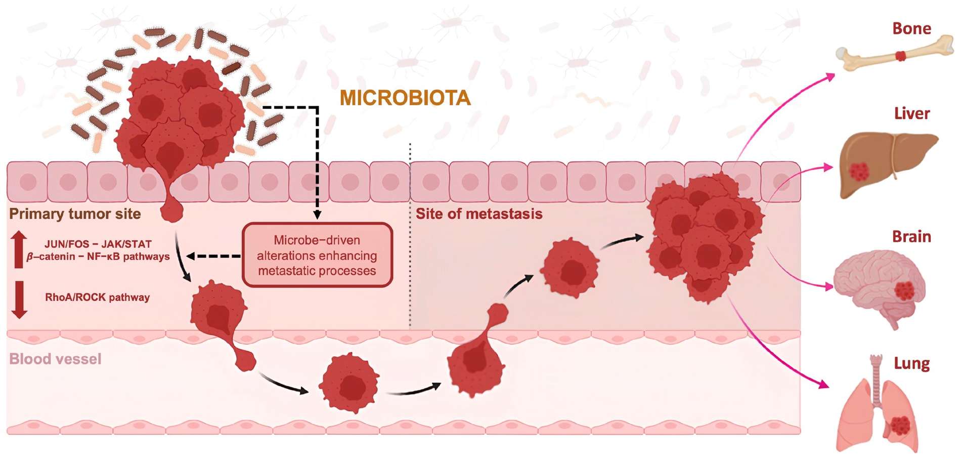 Fig.1 Intratumoral microbiota may facilitate metastasis formation. (OA Literature)