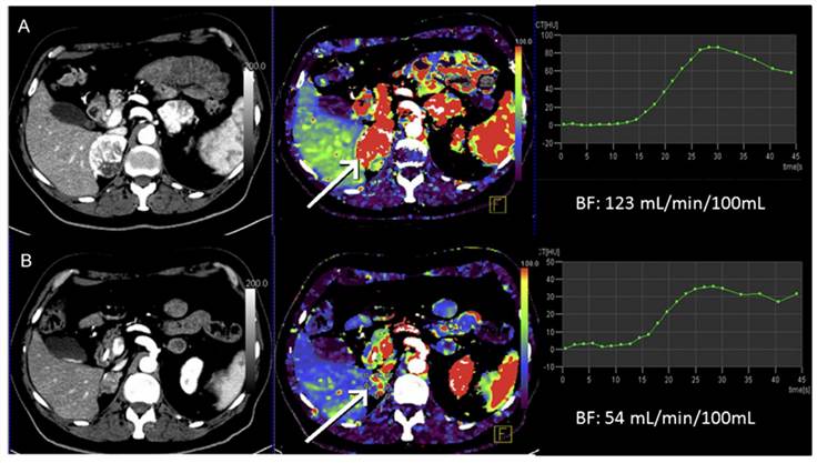 Conventional CT images and DCE-CT-derived regional blood flow maps.