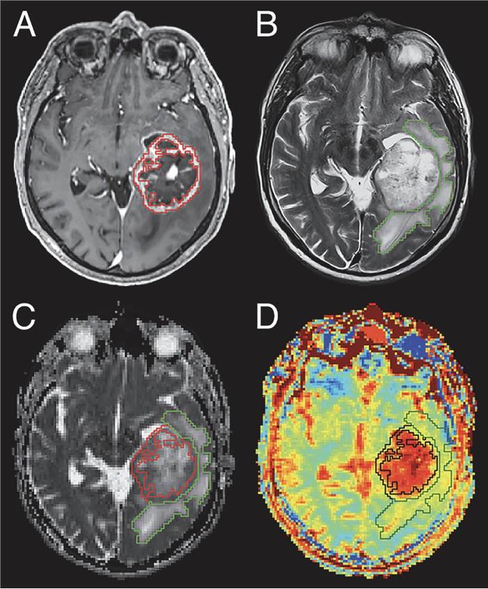 Contrast-Enhanced MRI Imaging in Glioblastoma.