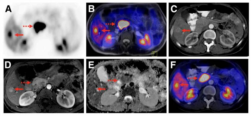 PET/CT and PET/MR Images in Pancreas Cancer and Liver Cancer.
