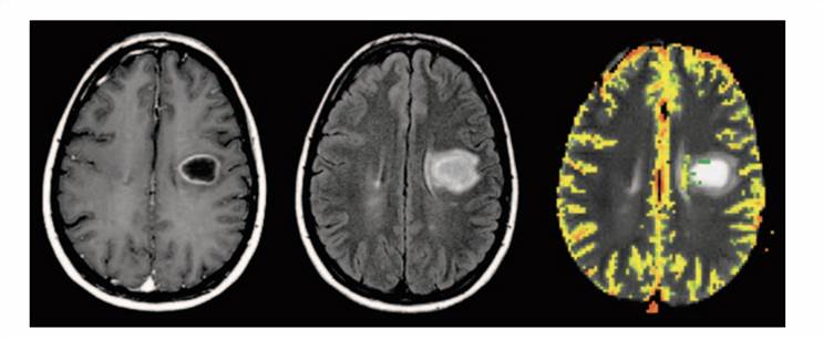 Dynamic Contrast-Enhanced Magnetic Resonance Imaging of Brain Tumor.