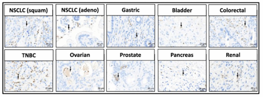 Fig.2 Arginase 1 is abundant in multiple types of cancer. (Steggerda, et al., 2017)