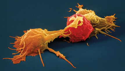 Natural killer cells (yellow) attack a cancer cell.