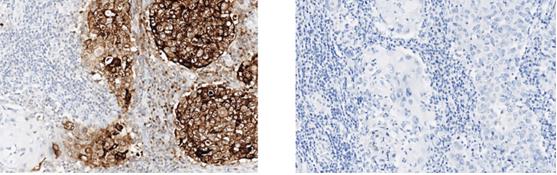 Fig.2 In-depth IHC analysis representing the staining of GCDFP-15 and TTF-1.