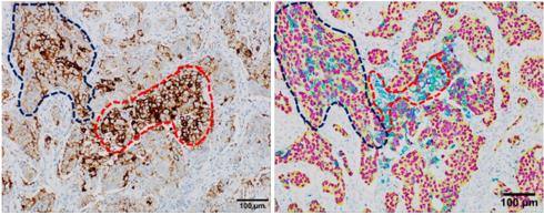 Fig.3 In-depth analysis using traditional immunoperoxidase staining and multiplexed immunohistochemistry (IHC).