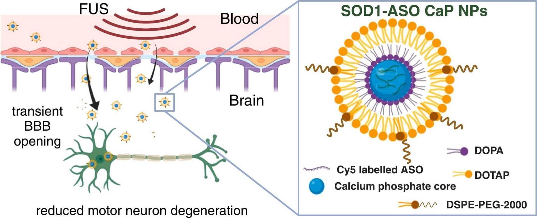 Lipid-based nanoparticles deliver ASO for the treatment of ALS. (OA Literature) 