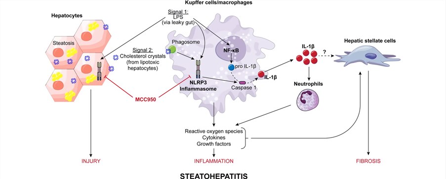 The pathogenesis of inflammation in NASH.