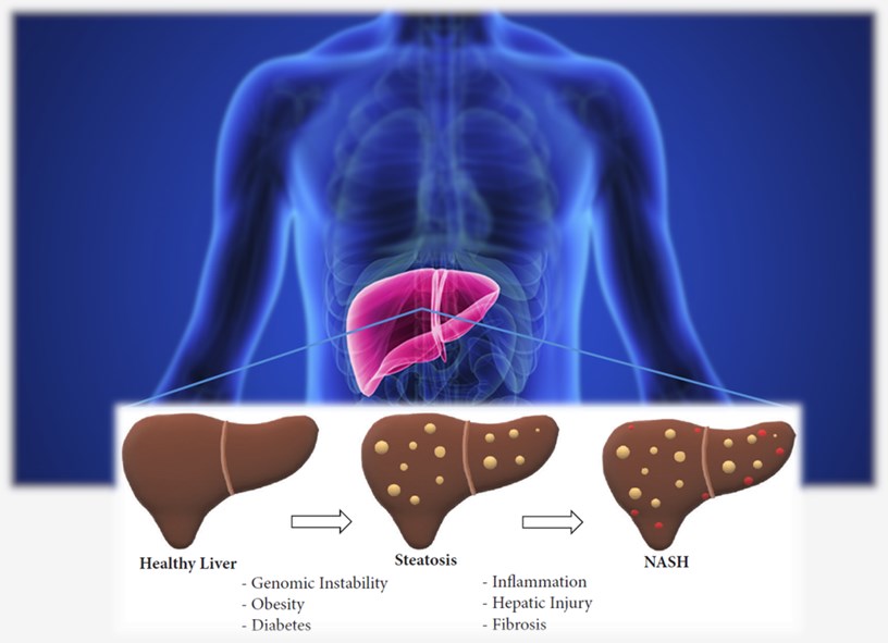 Development of NASH from healthy liver.