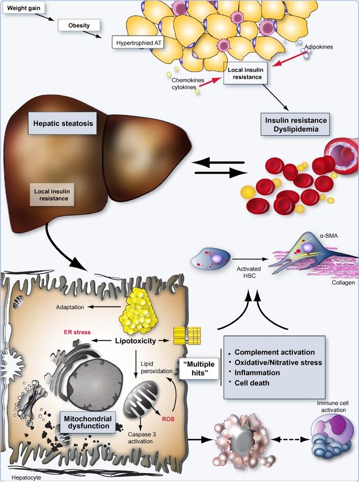 The substrate overload lipotoxic liver injury model illustrates the pathogenesis of NASH and targets of therapy.