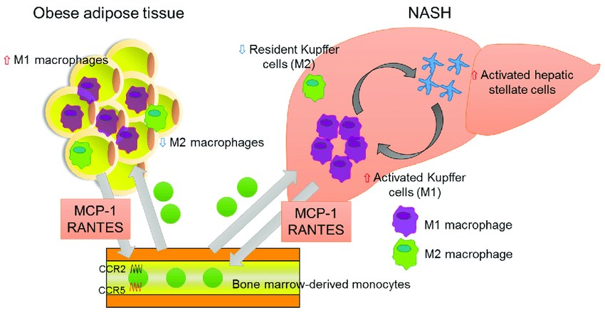  Association of chemokines and NASH.