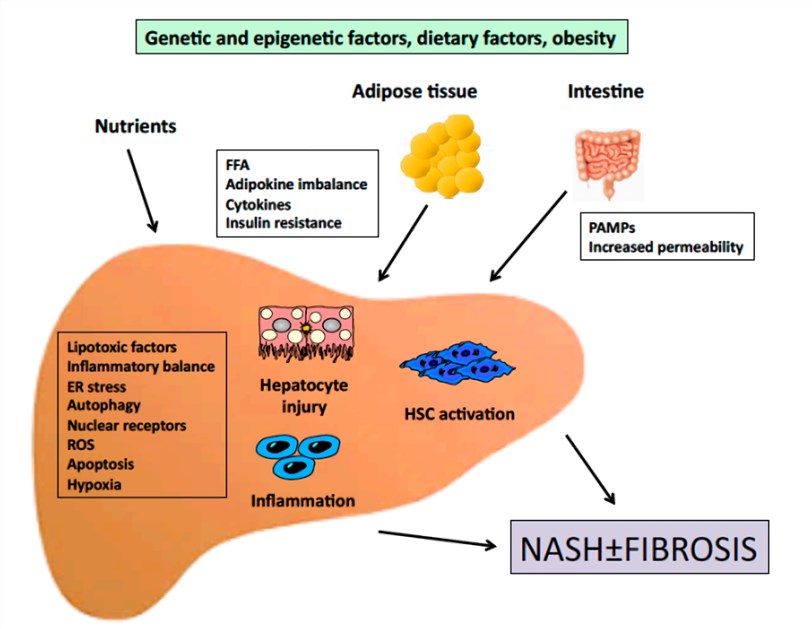 Outline of the pathogenesis of NASH.