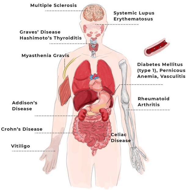 Fig.1 Overview of autoimmune diseases. (Ortet and Liliana, 2022)