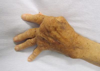 Fig.2 The symptoms of rheumatoid arthritis (a kind of autoimmune disorder). (https://commons.wikimedia.org/wiki/File:Rheumatoid_Arthritis.JPG)