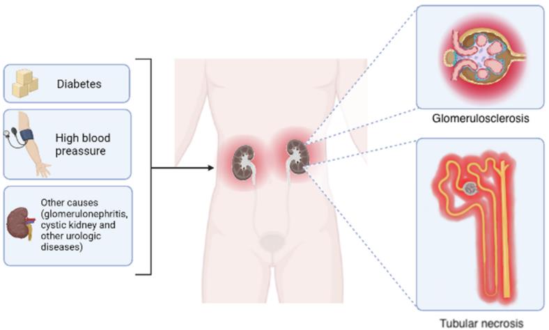 Fig.1 The chronic kidney disease basics. (Lucero, et al., 2022)